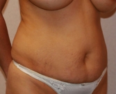 Feel Beautiful - Liposuction Case 8 - Before Photo